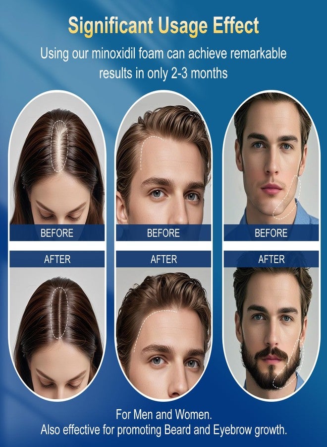 رغوة مينوكسيديل 5%، 5 قطع للرجال - معززة بالبيوتين، علاج لإعادة نمو الشعر للحصول على شعر ولحية أطول وأكثر كثافة (تكفي لمدة 5-6 أشهر) - Image 4